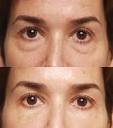 Miracl Eye Creme, 40gm