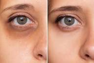Miracle with Hyaluronic Acid Eye Creme  Nourish Dark Circles